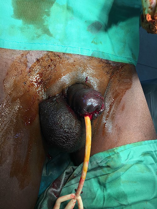 Image of post-penectomy reconstruction with testicular flaps and Foley catheter drainage. Some wound separation is noted at the reconstruction margins.