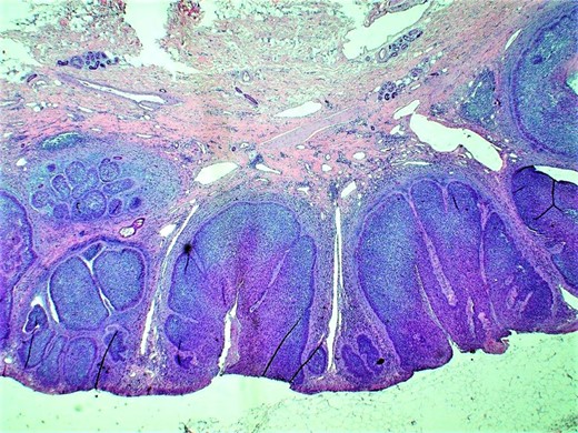 Histopathologic examination (H&E; original magnification: 200×) shows small and large nests of basal cell carcinoma within the epidermis and dermis, with typical nuclear palisading at the peripheral layer of the tumor. Picture also highlights dilation of the lymphatic channels within the dermis.