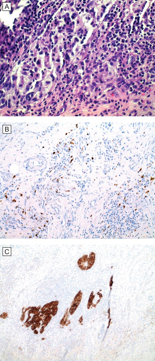 (A) Histopathologic examination (H&E; original magnification: 400×) shows small foci of residual and scant melanoma cells. (B and C), special stains (IHC; original magnification: 400×) MART1/MelanA and HMB45, respectively, are cytoplasmic stains that highlight the presence of scattered melanoma cells in the dermis.