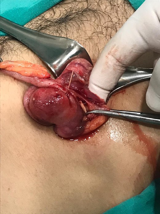 Two toothpicks, that perforate the appendix and the cecum.