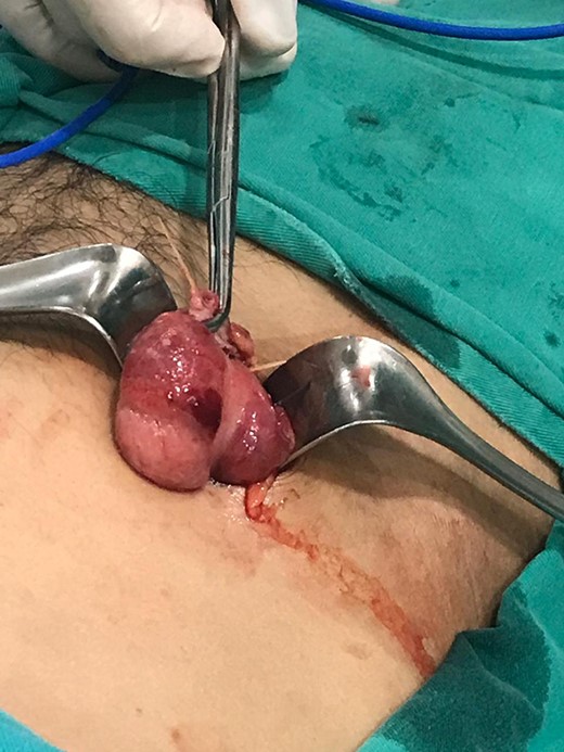 Hyperemic cecum wall with intense inflammation near the base of the appendix.