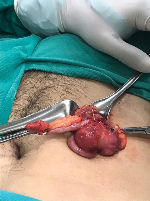 Transoperative image of the cecum and appendix with the two toothpicks.