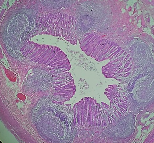 Pathology, appendix wall with acute mucosal inflammation and neutrophilic infiltrates in its wall.