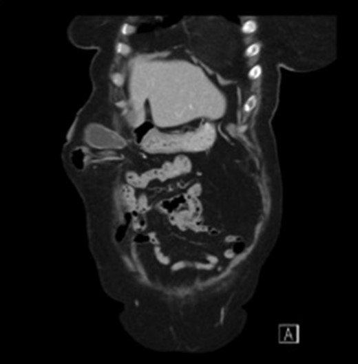 Sagittal view CT scan of the gallbladder in the parastomal hernia.