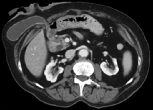 Axial view CT scan of the gallbladder in the parastomal hernia.
