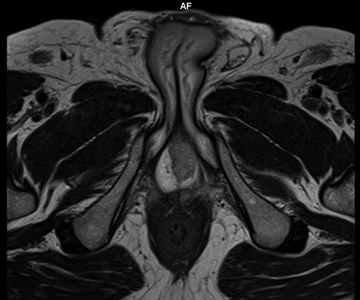 Axial T2 W images of penis showed a well-defined septated area of 2 cm in the posterior aspect of left corpus cavernosum.