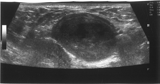 Ultrasound-guided puncture of the mixed echogenic cystic mass of left corpus cavernosum. White arrow: needle entry site.