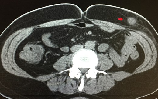 A 1.8 cm × 2 cm lesion (red arrow) revealed in CT scan within the subcutaneous fat.