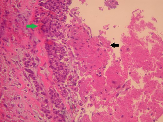 The lesion (green arrow) appears cystic due to its central tumor necrosis (black arrow). Hematoxylin and eosin ×200.