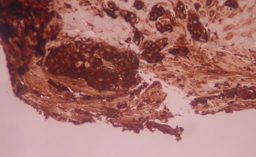 The tumor cells are positive for chymotrypsin in immunohistochemistry. Immunostaining ×200.