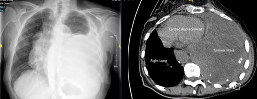 (a) CXR on presentation (b) CT chest.