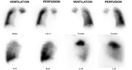 V-Q scan.