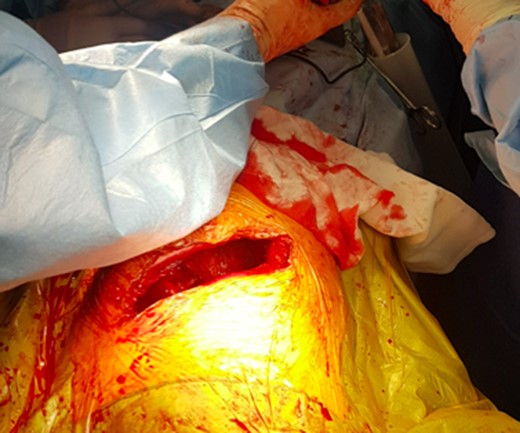Thoracotomy incision.