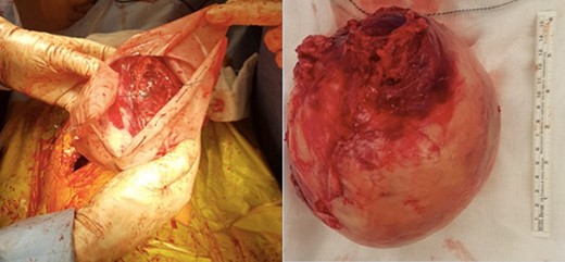 (a) Tumour extraction using specimen bag. (b) Tumour size ex-vivo.