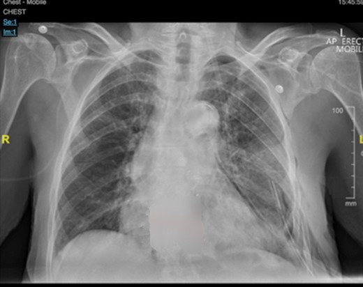 postoperative CXR.