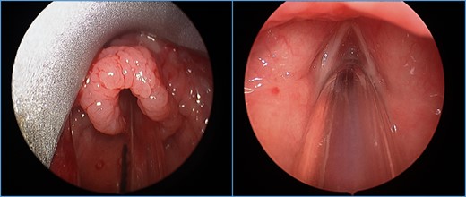 Polypoid changes noted circumferentially around the epiglottis extending to the aryepiglottic folds. Bilateral vocal folds visualized without changes.