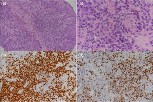 Low-power view (a) shows a dense subepithelial lymphoplasmacytic infiltrate and higher power view (b) shows admixed large transformed cells and rare eosinophils. CD3-positive T-cells (c) greatly outnumber CD20-positive B-cells (d).