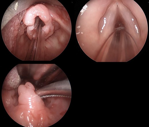 Infiltrate involving the supraglottic tissue but sparing the glottis. Irregular uvula with infiltrate.