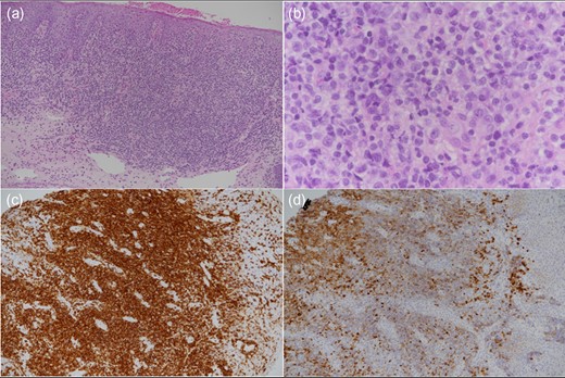 Low-power image (a) showing a dense subepithelial lymphoid infiltrate and higher power image (b) showing nuclear atypia in the small lymphoid cells and admixed larger transformed cells. CD3-positive T-cells (c) greatly outnumber CD20-positive B-cells (d).