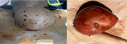 The cyst, preoperative (left) and a excised cyst with atrophied stamp (the arrow, right).