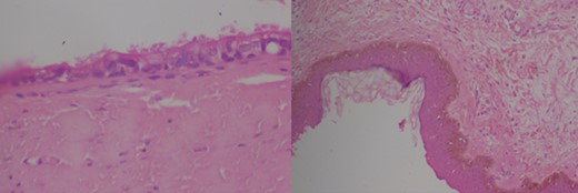 Pathology slides of the specimen confirming the diagnosis of TGDC (high and low power magnification).
