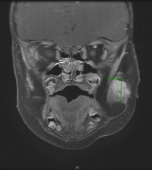 T2-weighted MRI revealed a homogenously enhancing 13 mm × 11 mm × 16.4 mm mass with indistinct margins centered within the left masseter muscle and protruding into the subcutaneous tissues laterally.