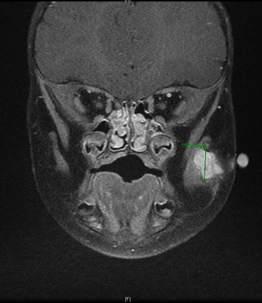 T2-weighted MRI 2 months later revealed a 14.5 mm × 14.1 mm × 15.95 mm mass partially involving the masseter muscle with no internal vascular flow voids.