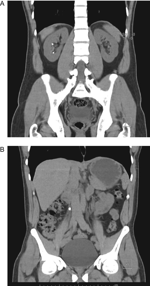 (A) CT, revealing bilateral nephrolithiasis. (B) CT, with a 7 mm hyperdense shadow in the middle of the right ureter.