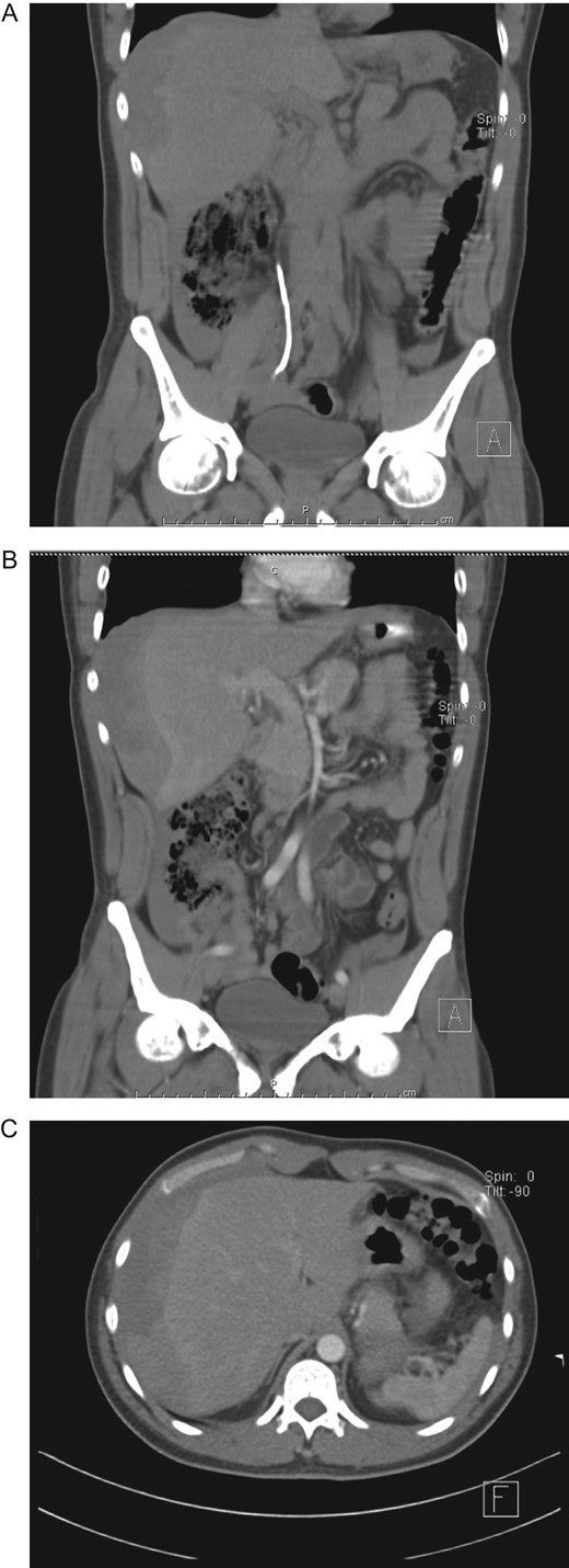 (A) CT, showing double J-stent and hepatic hematoma. (B) Contrast-enhanced CT, revealing a subcapsular liver hematoma. (C) Contrast-enhanced CT, subcapsular liver hematoma without contrast material extravasation.