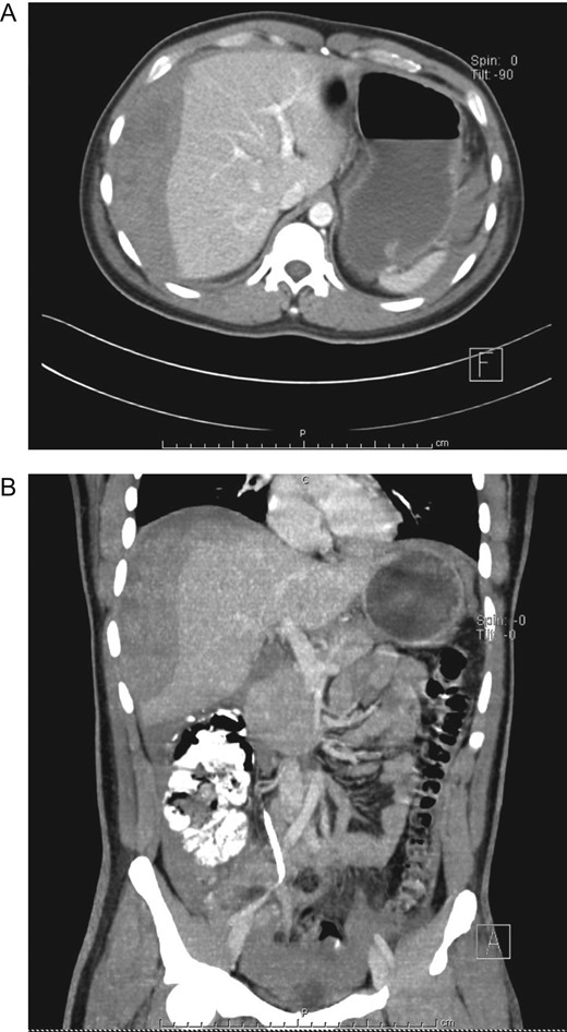 (A) Contrast-enhanced CT, subcapsular liver hematoma 48 h after admittance. (B) Contrast-enhanced CT, the liver hematoma had grown ~50%.