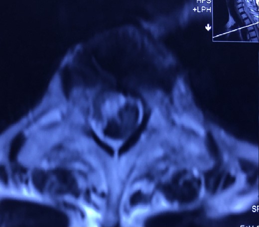 MRI shows subdural hematoma T4 to T7.