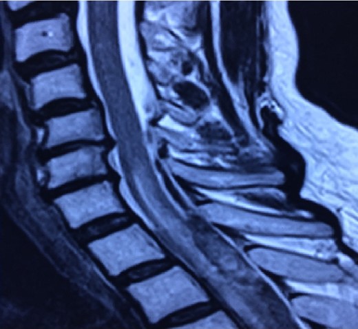 MRI shows subdural hematoma T4 to T7.