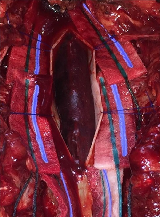 Presence of subdural hematoma after durotomy.