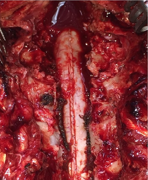 Image after drainage of the hematoma.