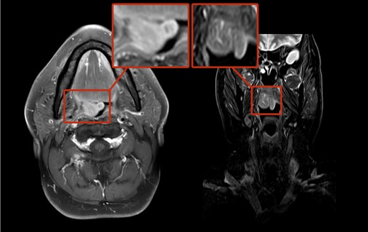 MRI scans of ARM involving the soft palate.