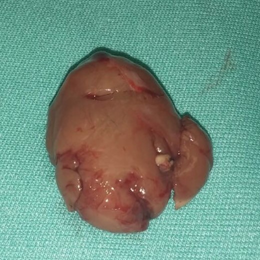 ARM of soft palate after excision.