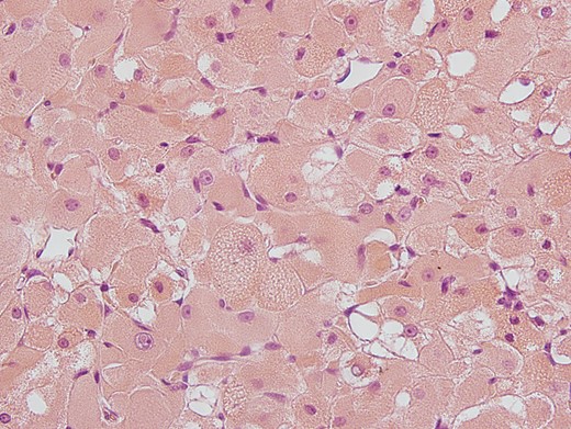 Hematoxylin-eosin (H&E) staining: polygonal cell formation with granular cross-striated eosinophil cytoplasm and large round vesicular nulei are seen.