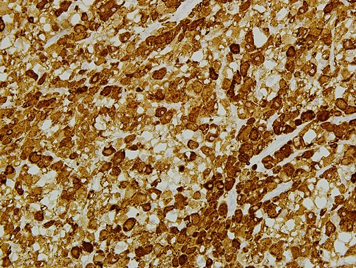 Immunohistological staining of EARM with desmin antibodies. Cytoplasma with positive antibodies for desmin is seen.