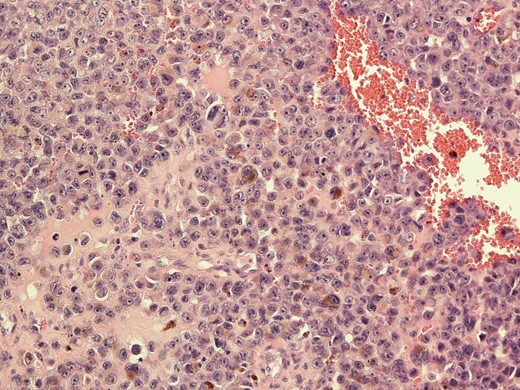 Histological image of metastatic melanoma with intracytoplasmic melanin pigment.