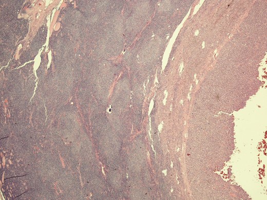 Microphotograph from node with metastatic melanoma on right and lymphoma involvement left of the slide.