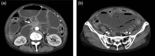 (a) Contrast-enhanced CT revealed a 48 × 28 mm mass in the pancreatic head (white arrow). Extensive intestine became ileus. (b) In the lower abdomen, the intestine showed no contrast effect, suggesting intestinal necrosis.