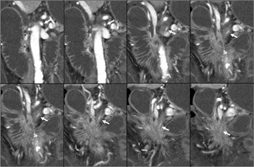 Pancreatic head cancer invaded the whole circumference of the SMA (white arrow), and the SMA showed stenosis and occlusion.