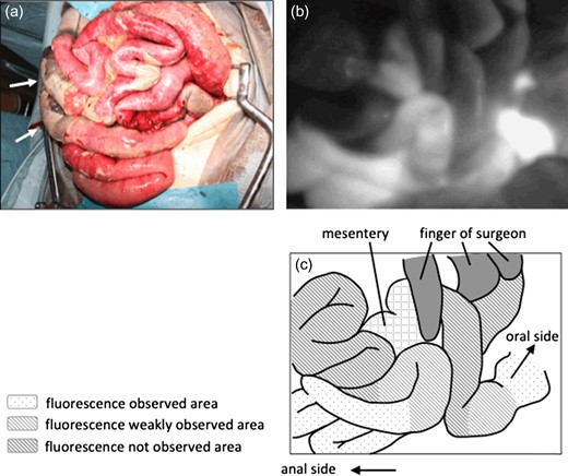 (a) On laparotomy, extensive ischemia of the intestine was noted. The white arrow demonstrates the necrotic intestine. (b) ICG fluorescent imaging revealed the ischemic area of the intestine. Three areas were showed, severe ischemic area, slightly ischemic area and non-ischemic area. (c) Illustration of ICG fluorescent imaging.