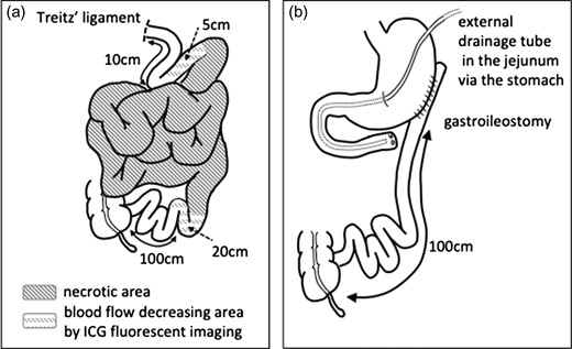 (a) The small intestine was necrotic between the jejunum (15 cm on the anal side from the ligament of Treitz) and the ileum (120 cm on the oral side from the terminal ileum). ICG fluorescent imaging revealed that the blood flow was decreased between the jejunum (10 cm on the anal side from the ligament of Treitz) and the ileum (100 cm on the oral side from the terminal ileum). (b) The dilated jejunal stump was closed, an external drainage tube was inserted in the jejunum via the stomach, and gastroileostomy was performed.