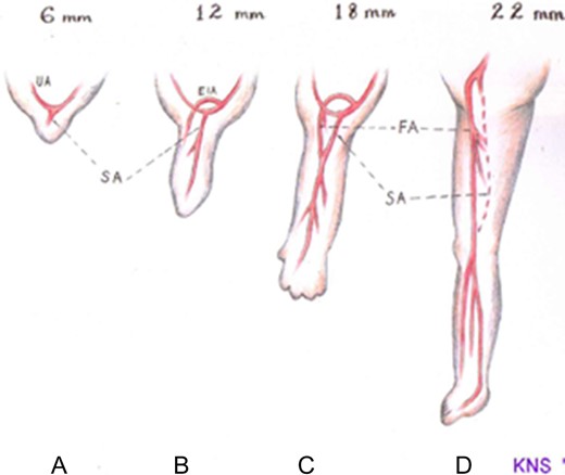 Schematic drawing showing the normal embryonic arterial development of the lower limb. (a) At the 6 mm embryo stage, the primitive sciatic artery (SA) has arisen from the umbilical artery (UA) and begins to supply the limb bud. (b) At the 12 mm embryo stage, the external iliac artery (EIA) develops from the umbilical artery proximal to the origin of the sciatic artery. (c) At the 18 mm embryo stage, the EIA extends into the common femoral artery (FA) which then continues as the superficial femoral artery after giving off its profunda branch. The sciatic artery develops a communication with the distal superficial femoral artery and itself begins to involute. (d) At the 22 m embryo stage, the sciatic artery has completely involuted save for its proximal end which persists as the inferior gluteal artery. The femoral artery is now the dominant blood supply to the lower limb.