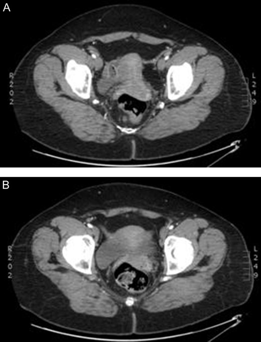 Enhanced computed tomography scan of a 52 year old woman with right lower limb ischaemia showing (A) bilateral persistent sciatic arteries entering greater sciatic foramen, and (B) a few slices inferiorly a thrombus occluding the right sciatic artery.