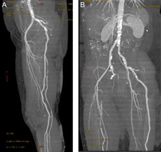 Enhanced three-dimensionally reconstructed computed tomography angiogram, showing (A) the internal iliac artery continuing as the sciatic artery and popliteal artery bilaterally, with hypoplastic superficial femoral arteries supplying the upper thigh. The angiogram also demonstrates (B) the occlusion in the right sciatic artery at the sciatic notch, with reconstitution in the distal thigh).