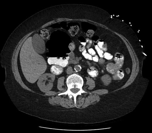 Axial slice of computed tomography (CT) scan—giant diverticulum with air-fluid level containing oral contrast.