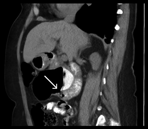 Sagittal slice of computed tomography (CT) scan—giant duodenal diverticulum partly filled with oral contrast. The arrow is indicating the neck of the diverticulum.