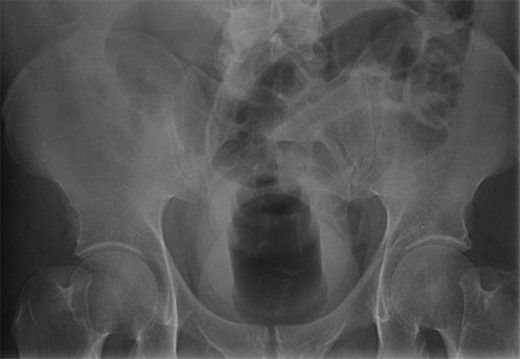 Abdominal X ray showing a large, mixed low and high-density foreign body in the rectosigmoid.